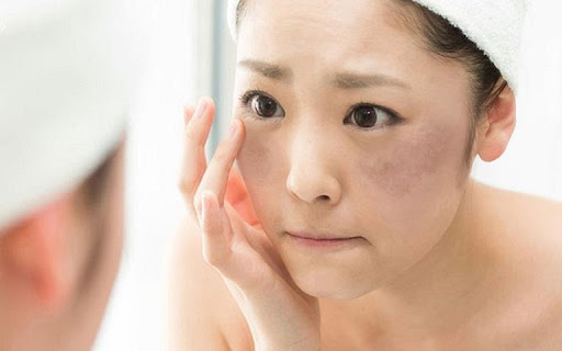 10 phuong phap tu nhien giup tri nam da hieu qua tai nha 14 10 phuong phap tu nhien giup tri nam da hieu qua tai nha 14