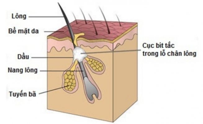 10 Sự Thật Về Mụn Ẩn Dưới Da Và Cách Điều Trị Hiệu Quả Nhất