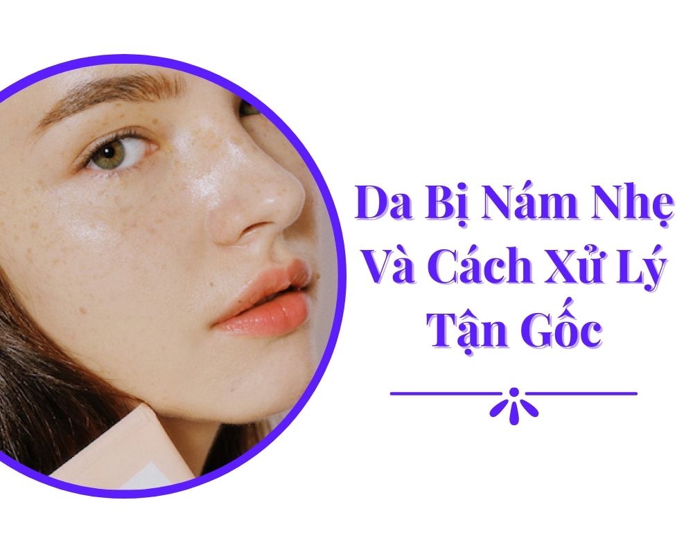 da bi nam nhe va cach xu ly tan goc miri.com .vn 8