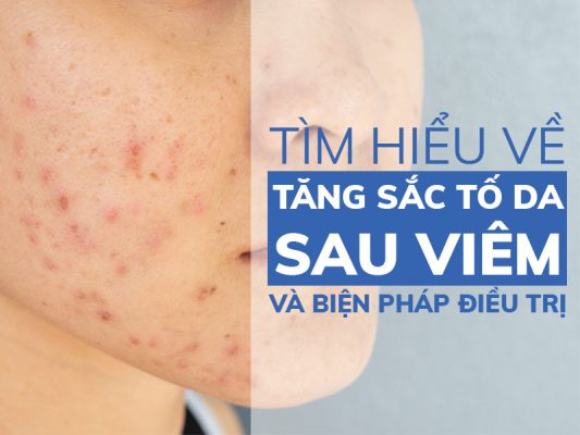tim hieu ve tang sac to da sau viem va bien phap dieu tri miri.com .vn 7