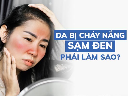 da bi chay nang sam den phai lam sao miri.com .vn 1