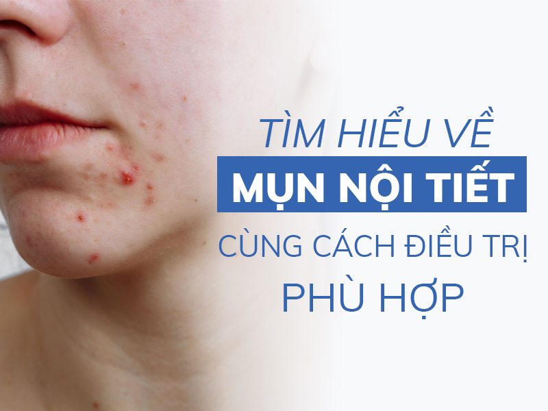 tim hieu ve mun noi tiet cung cach dieu tri phu hop niri.com .vn 4