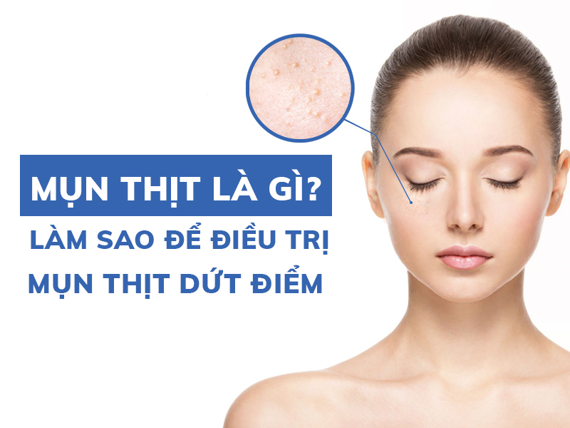 mun thit la gi lam sao de dieu tri mun thit dut diem miri.com .vn 5