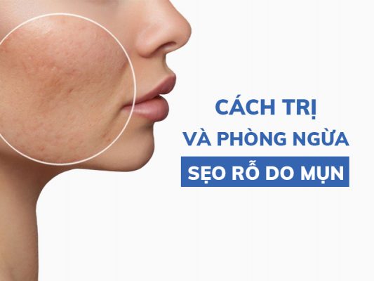 cach tri va phong ngua seo ro do mun miri.com .vn 4