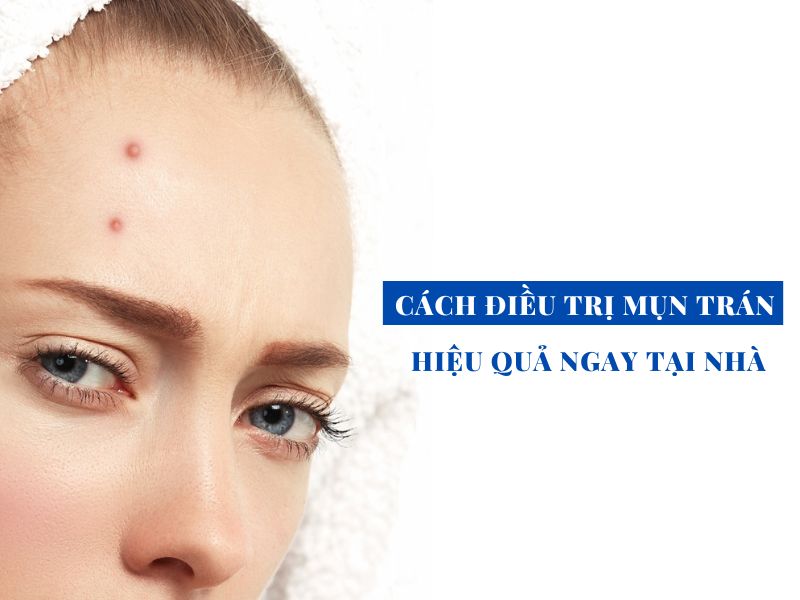 nguyen nhan va cach dieu tri mun tran hieu qua miri.com .vn 6