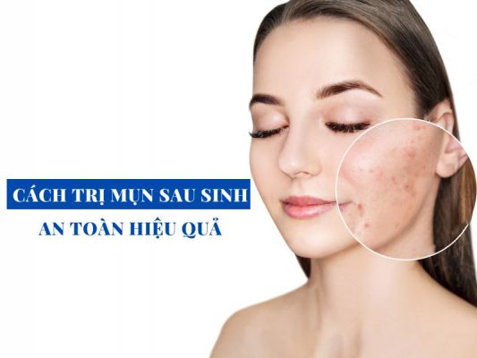 tim cach tri mun sau sinh an toan hieu qua cho cac me bim miri.com .vn 3