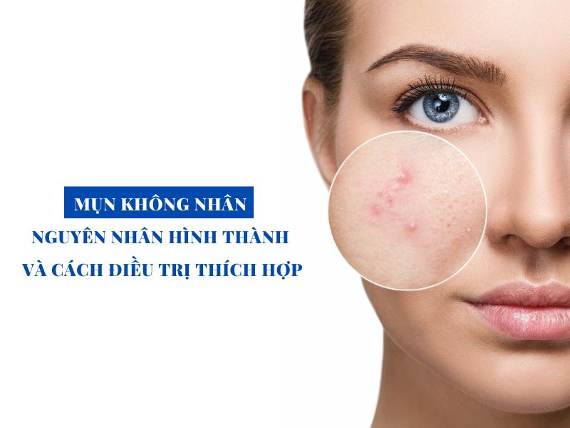 mun khong nhan nguyen nhan hinh thanh va cach dieu tri miri.com .vn 3