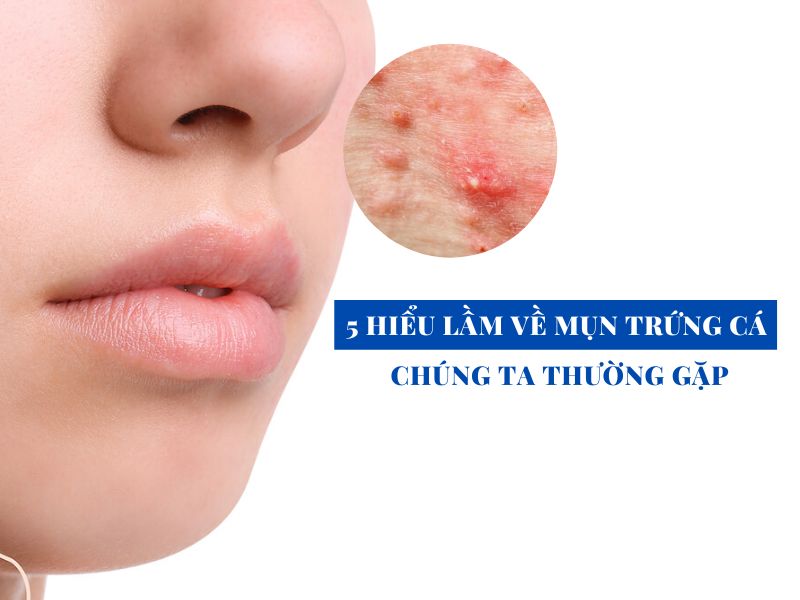 5 hieu lam ve mun trung ca thuong gap miri.com .vn 4