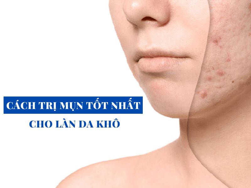 cach tri mun tot nhat cho lan da kho miri.com .vn 3