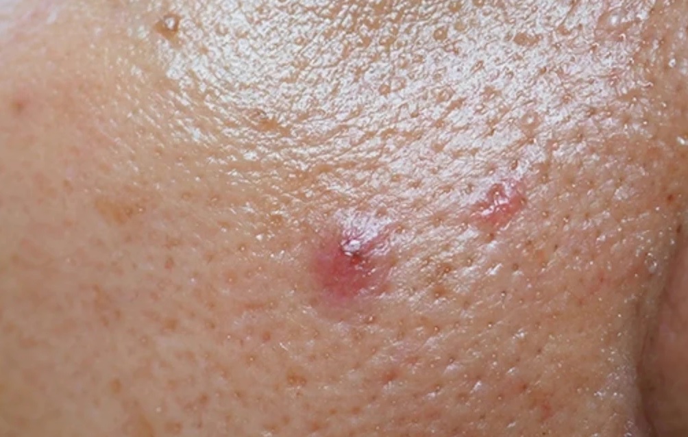 top san pham cuu canh cho lan da nhon mun miri.com .vn