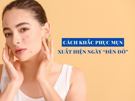 cach khac phuc mun xuat hien ngay den do miri.com .vn 4