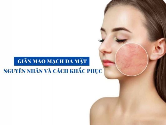 gian mao mach da mat nguyen nhan va cach khac phuc miri.com .vn 5