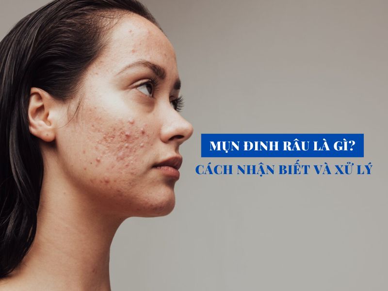 mun dinh rau la gi cach nhan biet va xu ly miri.com .vn 5