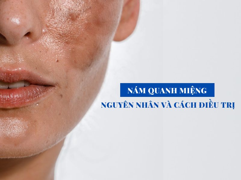 nam quanh mieng nguyen nhan va cach dieu tri miri.com .vn 6