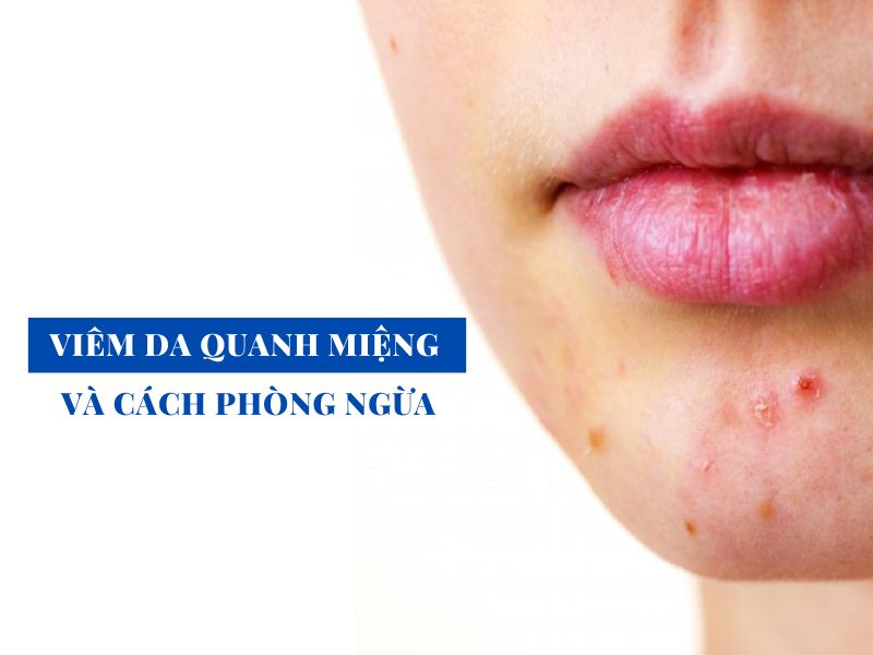 tim hieu ve viem da quanh mieng va cach phong ngua miri.com .vn 6