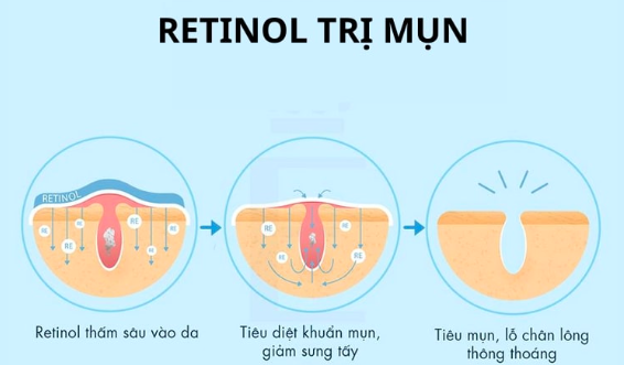 top 5 thanh phan tot cho da mun ma ban nen biet 5